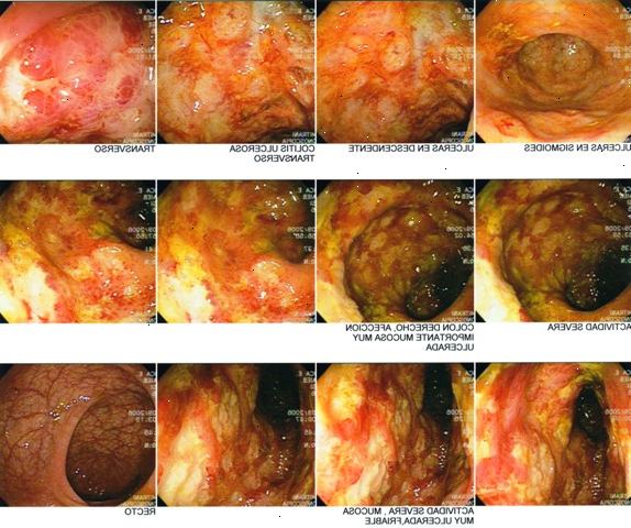 Rollen av kirurgi vid Crohns sjukdom behandling. Crohns sjukdom kirurgi: strictureplasty.