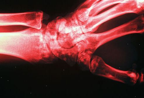 Hur benförlust kan utvecklas till benskörhet. Osteopeni: förståelse benförlust.