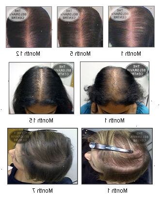 Minoxidil för håravfall hos kvinnor. 7 saker att inte göra för håravfall.