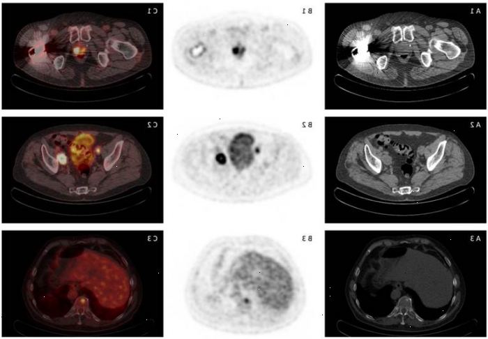 Prostatacancer iscensättning: imaging och lymfkörtelbiopsi. Röntgenundersökningar används för prostatacancer staging.