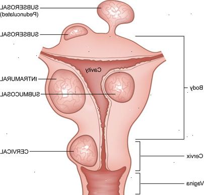 Fibroida smärta: bortom livmodern. Effekterna av fibroids på andra organ.
