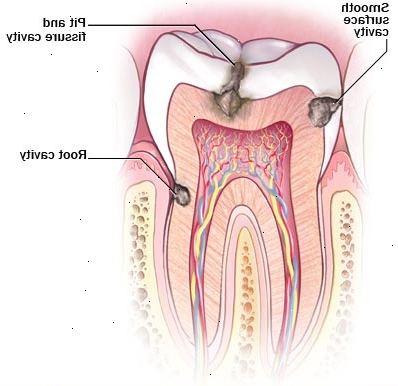 Tandfyllning alternativ för håligheter. Hur hålrum behandlas?