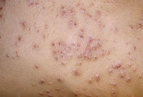 Hur kan man förhindra infektioner eksem hud. Styra eksem för att förhindra hudinfektioner.